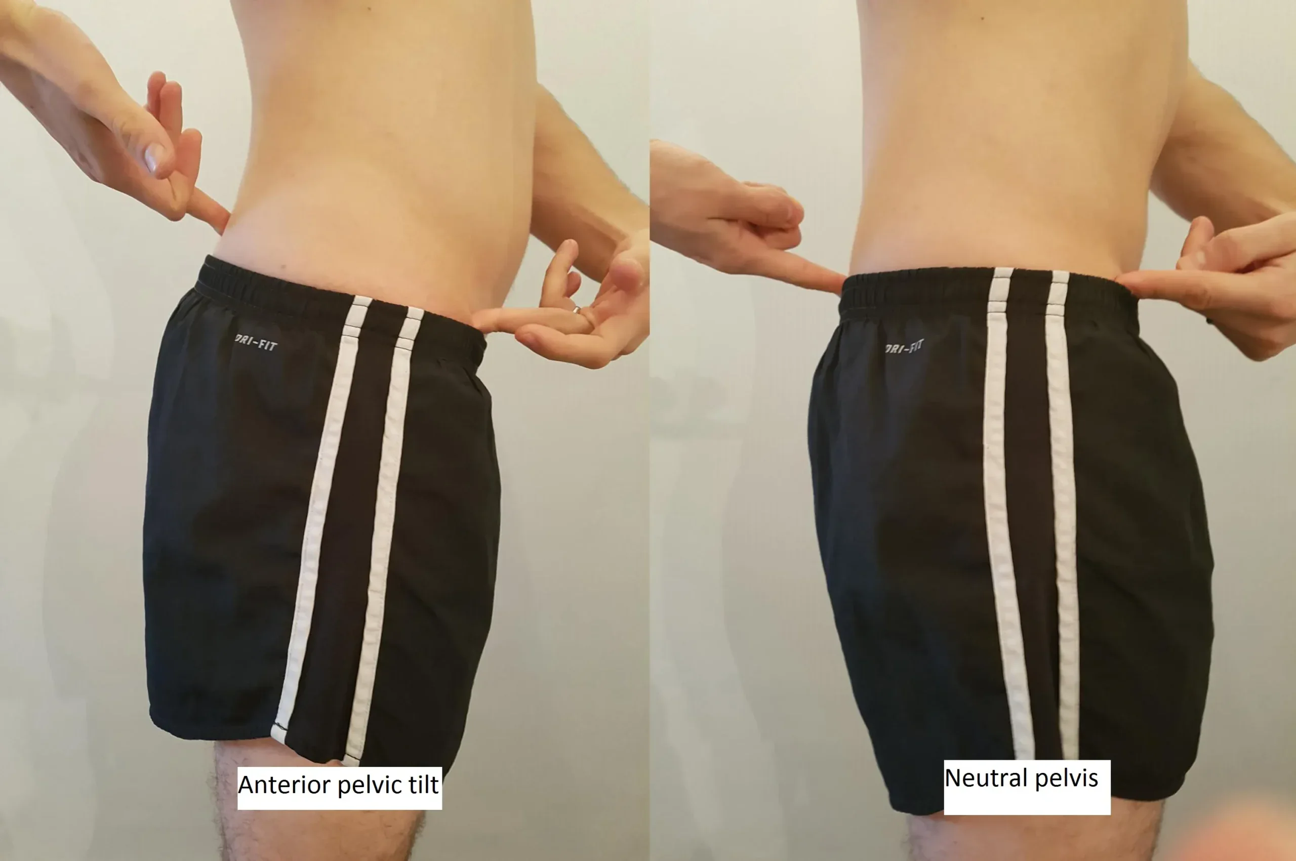 A photo showing anterior pelvic tilt