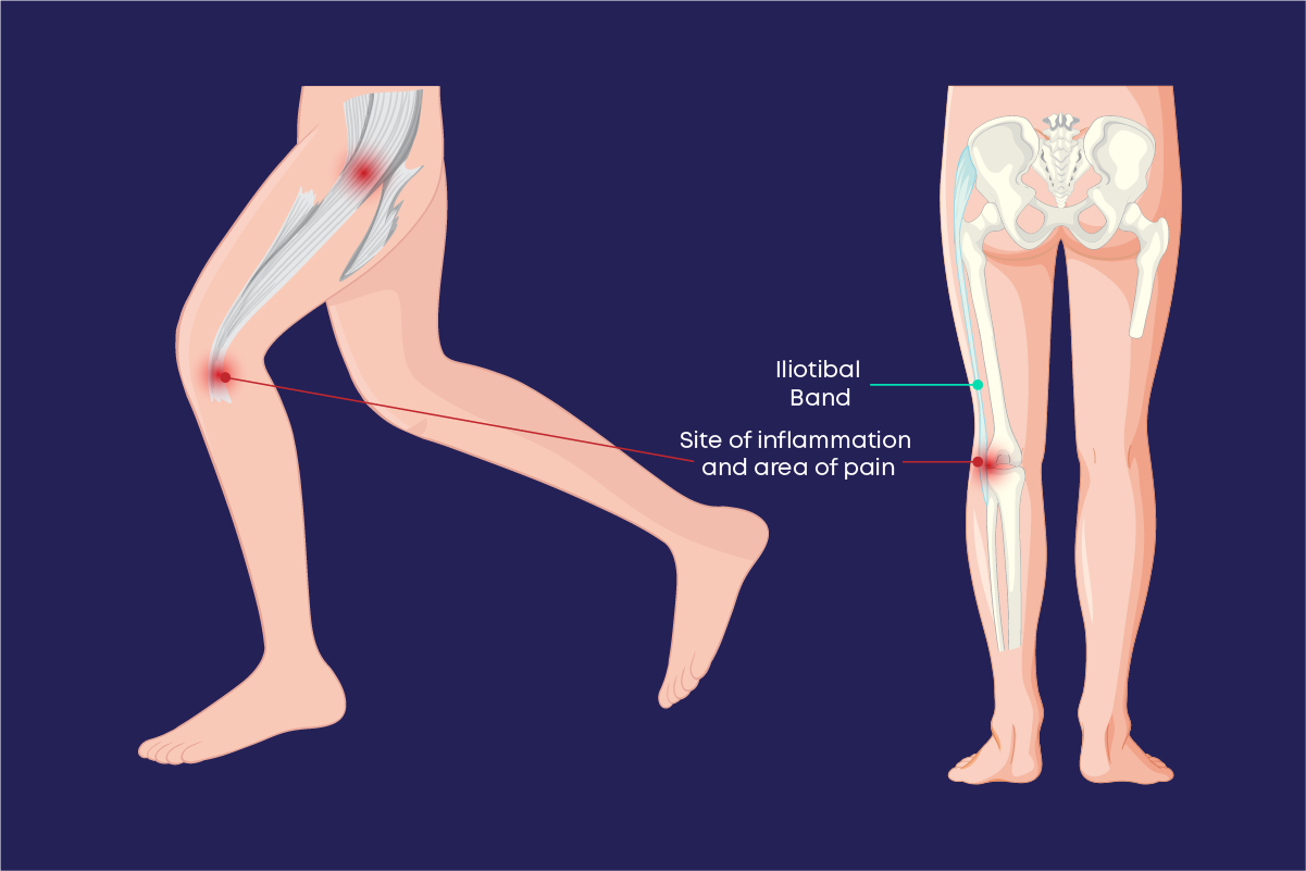 A diagram showing the IT band