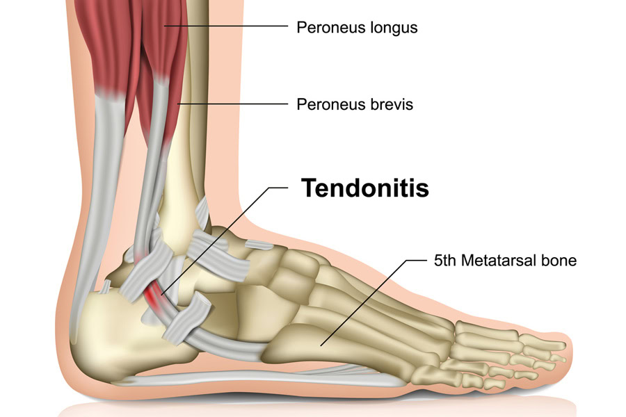 Tendonitis